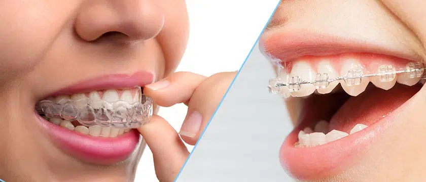 https://misodent.ro/wp-content/uploads/2025/04/aparat-dentar.webp