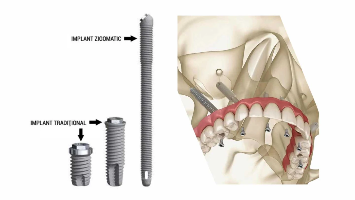 https://misodent.ro/wp-content/uploads/2025/05/implant-zigomatic.webp