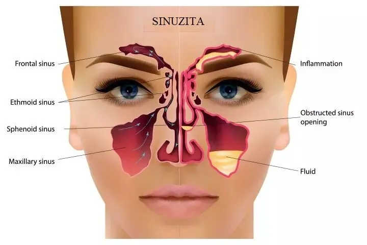 https://misodent.ro/wp-content/uploads/2025/05/sinuzita-maxila.webp
