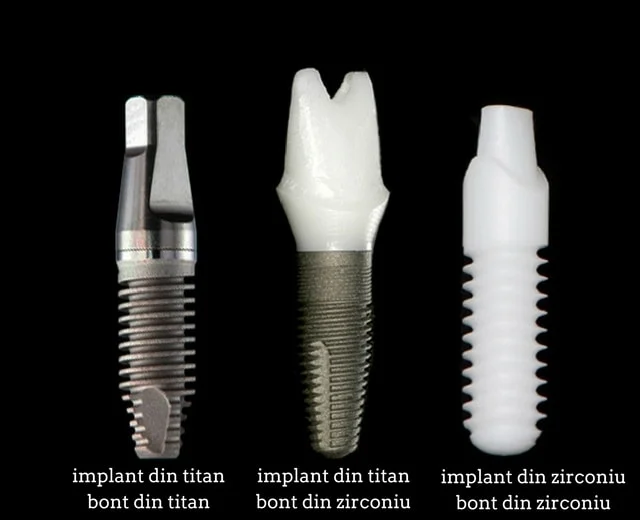 https://misodent.ro/wp-content/uploads/2025/05/tipuri-implant.webp