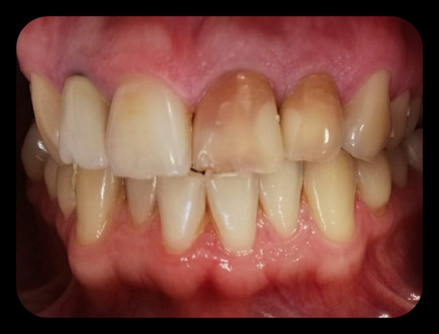 https://misodent.ro/wp-content/uploads/2025/06/albire-endodontica.jpeg