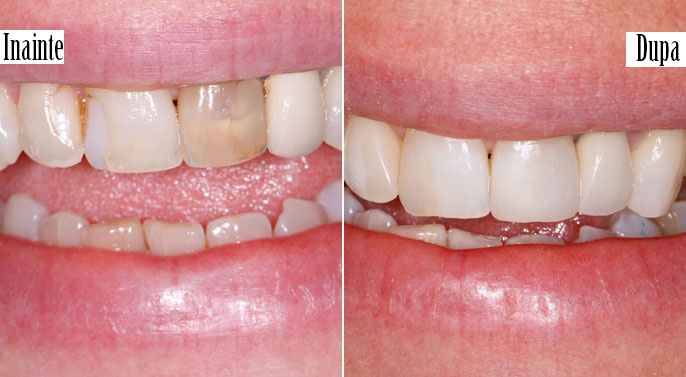https://misodent.ro/wp-content/uploads/2025/06/before-and-after-albire-interna-1.jpeg