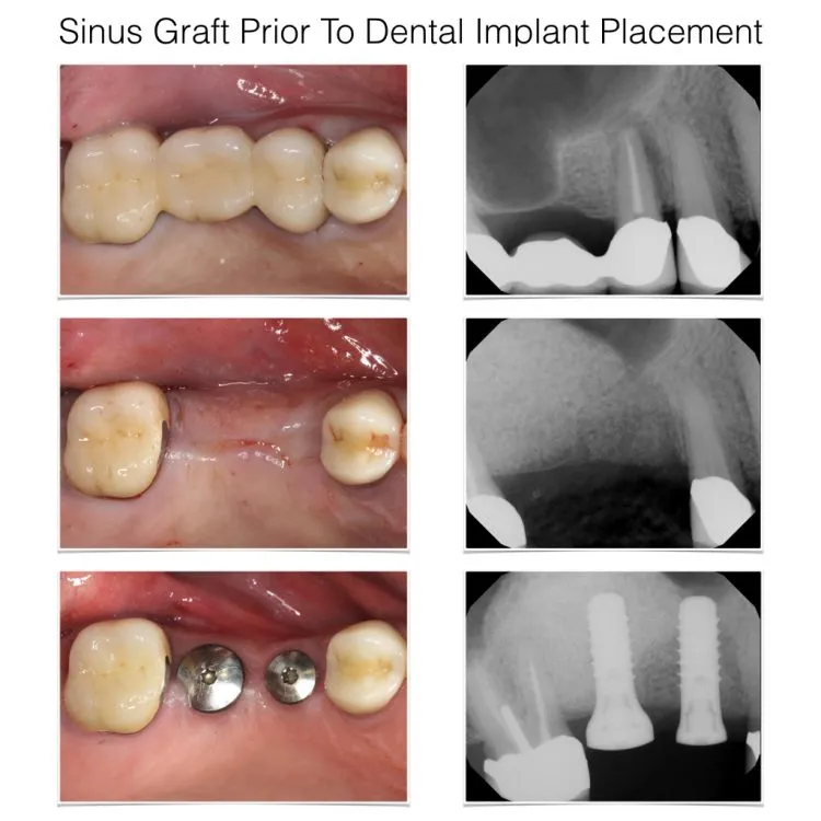 https://misodent.ro/wp-content/uploads/2025/08/sinus-lift-before-and-after.webp