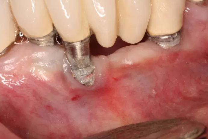 https://misodent.ro/wp-content/uploads/2025/09/periimplantita.webp
